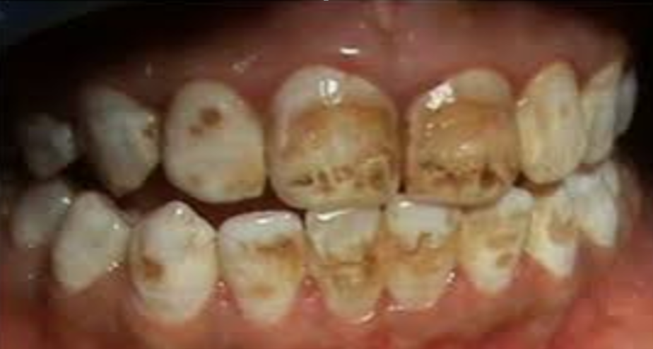dental flourisis 7