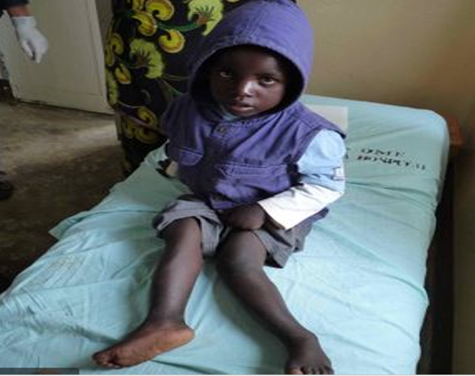 skeletal flourisis 1